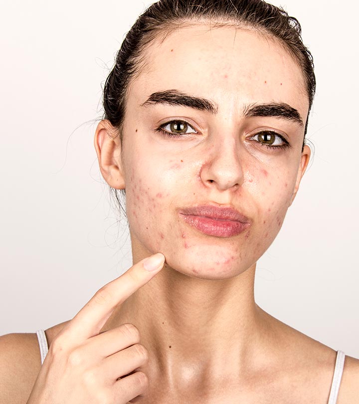 Hormonal Acne: How To Treat It Effectively