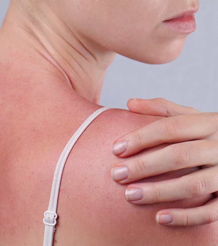 10 Natural Remedies To Treat Sun Poisoning At Home